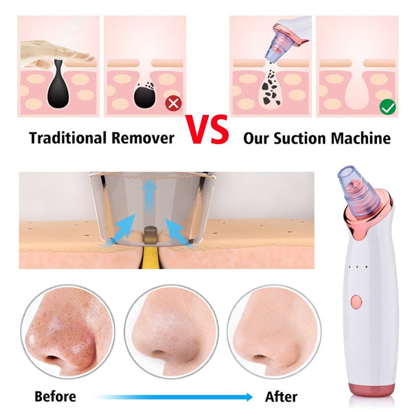 Blackhead Instrument Electric Suction Facial Washing Instrument Beauty Acne Cleaning Blackhead Suction Instrument - happyshop365247